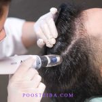 hair mesotherapy
